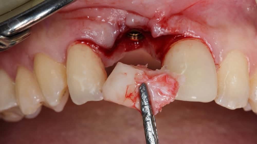 Microcirugía periodontal e injerto de encía